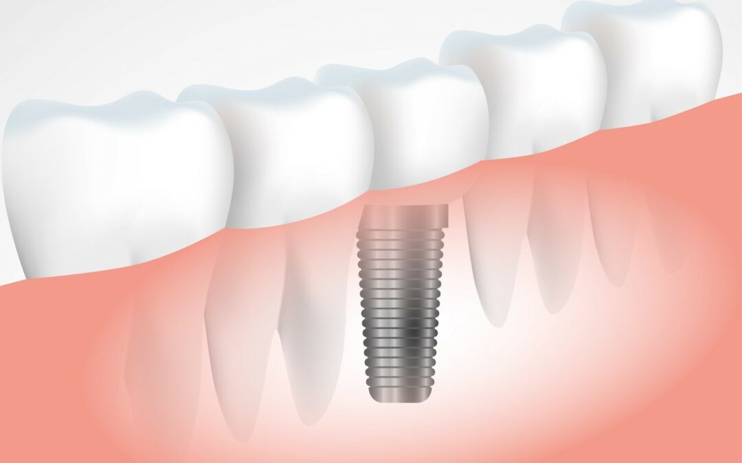 La importancia de reponer los dientes perdidos con implantes