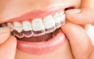 Invisalign: la ortodoncia que estabas esperando