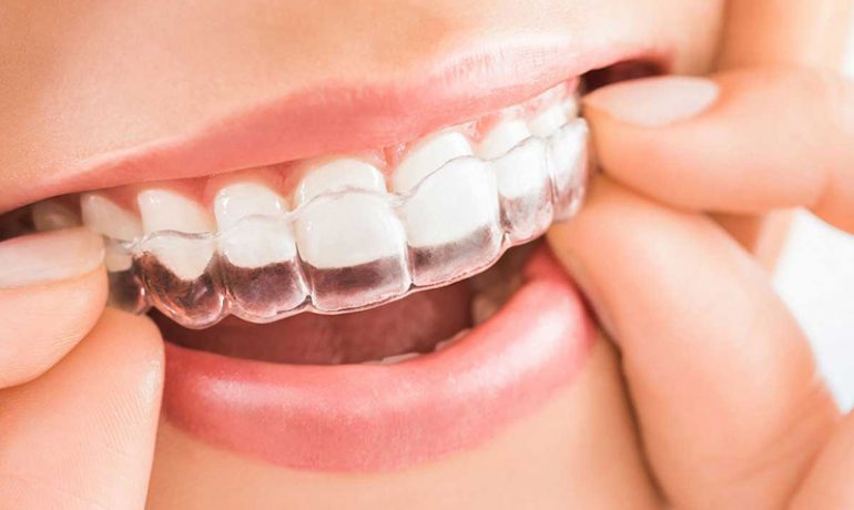 Invisalign: la ortodoncia que estabas esperando