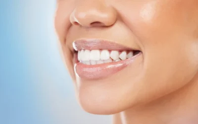 Blanqueamiento dental: tipos, precio y cuánto dura