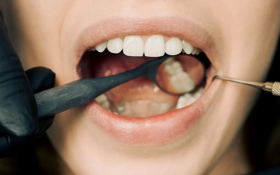 Dentista explorando la mucosa de la boca de una paciente con un espejo dental para revisar una llaga